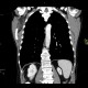 Fatty degeneration of subscapular muscle: CT - Computed tomography